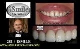 tooth implant Houston Sugar land