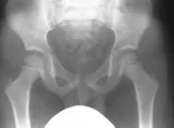 What are the symptoms of Perthes disease