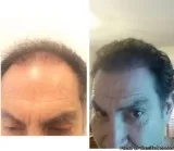est Hair Loss Treatment in the UK