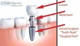 Looking for Dental Implants Treatment Burbank City California