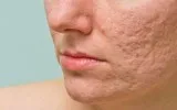 Acne Scars Treatment in Gurgaon