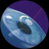Fast Smile Vision Surgery