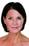Sun Damage Toronto