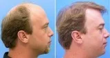 Avail Hair Transplant Treatement In Chandigarh- TIPS Institute