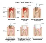Root Canal Dentist in Pune