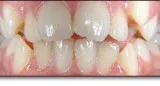 Invisalign Treatment in Waterloo by Eastbridge Dental Care