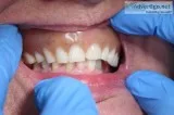 All on 4 dental implants services in las vegasABC DENTAL