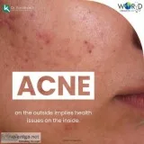 Acne Treatment in Delhi by Specialist