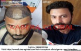 Enhance Hair Quality at Best Hair Transplant Clinic in Jalandhar