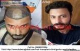 Enhance Hair Quality at Best Hair Transplant Clinic in Jalandhar