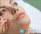 Lip fillers london