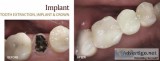 Dental Implants Brockville