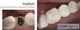 Dental Implants Brockville
