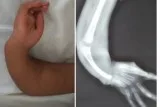 What causes radial club hand