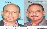 Restore Hair from Best Hair Transplant Clinic in Punjab