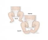 What causes clubfoot in a fetus