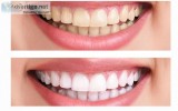 Teeth whitening in Gurgaon Palam Vihar  Dr Bhatias Dental Clinic