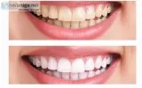 Teeth whitening in Gurgaon Palam Vihar  Dr Bhatias Dental Clinic