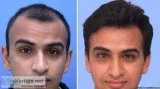 Hair Transplantation in India  Sage Hair