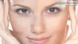 Skin Pigmentation Causes and Treatment