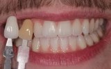 Teeth Whitening in Gurgaon  Teeth bleaching in Gurgaon