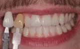 Teeth Whitening in Gurgaon  Teeth bleaching in Gurgaon