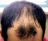 Hair thinning - Hair Centre International