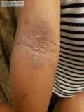 Eczema