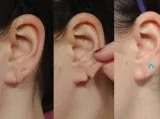Ear Lobe Repair - RoyalLush