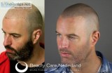 Baldness Cure-Scalp Micropigmentation