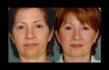 Facelift Miami - Dr. Ramirez Plastic Surgeon
