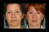 Facelift Miami - Dr. Ramirez Plastic Surgeon