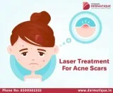 Best Laser treatment for acne scars in Hyderabad