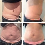 Weight Loss Treatment In Chennai