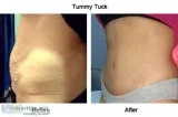 Skin Tightening Treatment In Chennai