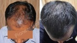 Best Hair Transplant Bangalore