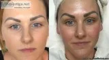 Cryo Surgery