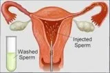IUI Procedure