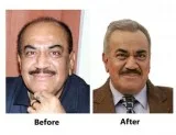 hair transplant in mumbai
