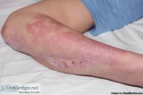 Paid Adult Plaque Psoriasis Study Call to learn more