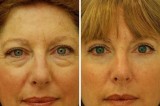 Eyelids surgery Miami - Dr. Ramirez Plastic Surgeon