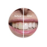 Buy Teeth Whitening Products for Sale  Teethwhiteninghomeki t.co