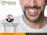 High-Quality Dental Implants in Hyderabad and Secunderabad
