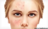 Acne Scars Treatment