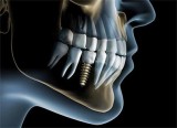 Dental Implants Clinic in Gurgaon - Punyam Dental Office