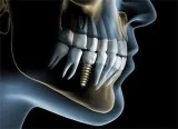 Dental Implants Clinic in Gurgaon - Punyam Dental Office