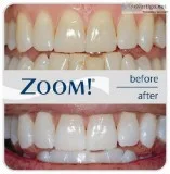 Philip Zoom LED Whitening is here 