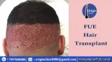 hair fall solution  fue hair transplant  hair fall solution in h