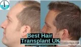 Hair Transplant In UK - Revive Hair and Skin Clinic
