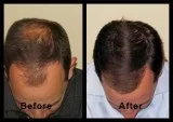Best Hair Transplant Clinic in Hyderabad  Hair Transplant cost i